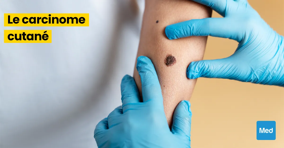  Tout ce que vous devez savoir sur le carcinome cutané